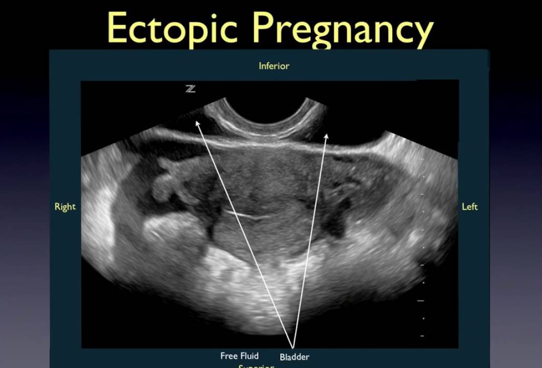 Ectopic Pregnancy Scan