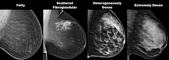 Mammography In Vivek Vihar, Delhi
