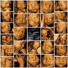 3D/4D Sonography