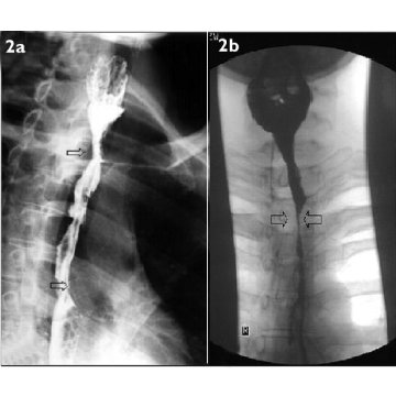 Barium Studies